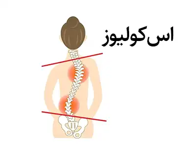 اسکولیوز چ شکلیه