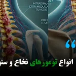 انواع تومورهای نخاع و ستون فقرات + درمان و علائم