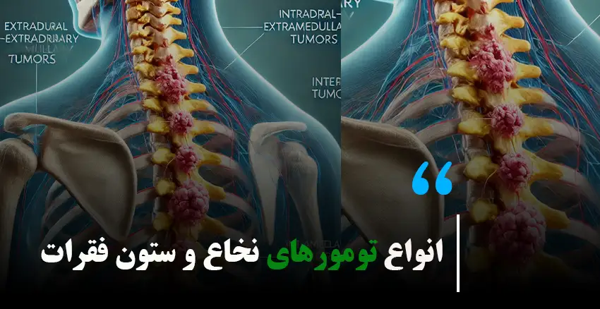 انواع تومورهای نخاع و ستون فقرات + درمان و علائم