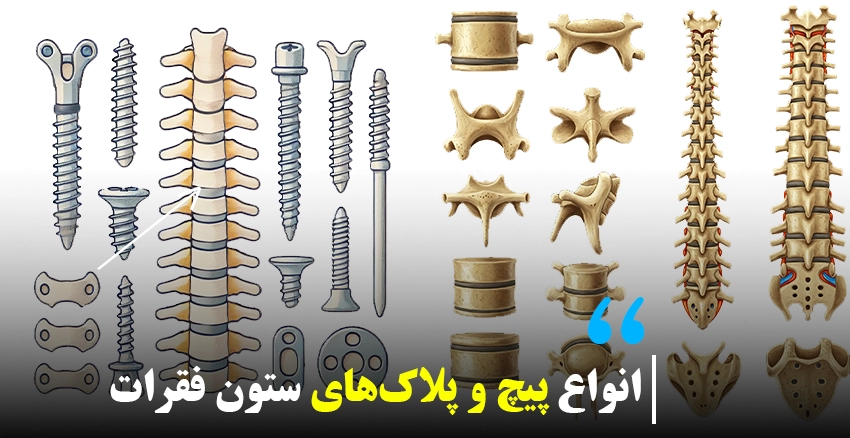 انواع پیچ و پلاک‌های ستون فقرات