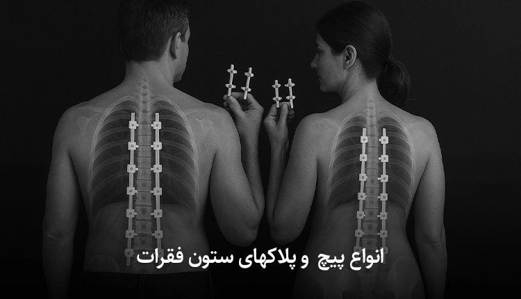 انواع پیچ‌ های ستون فقرات