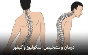 درمان و تشخیص اسکولیوز و کیفوز