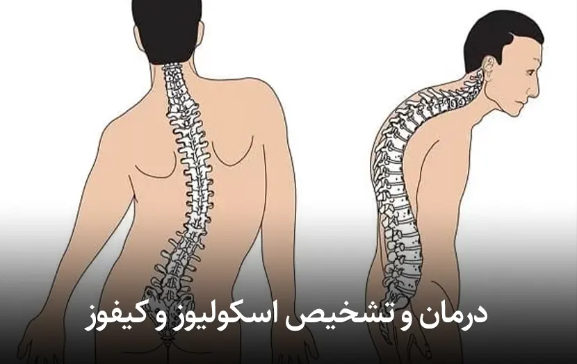 درمان و تشخیص اسکولیوز و کیفوز