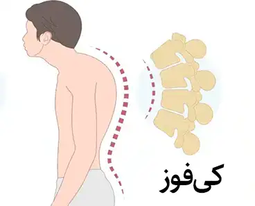 کی فوز (Kyphosis) به خمیدگی  ستون فقرات در ناحیه قفسه سینه که قوز یا برجستگی در قسمت فوقانی کمر می‌گردد.