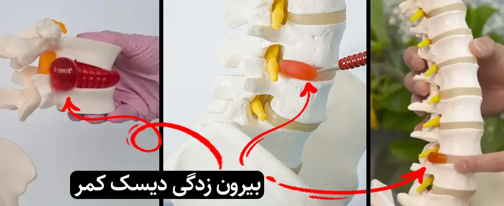 راهنمای جامع جراحی دیسک کمر و گردن 1 بیرون زدگی دیسک کمر در تهران