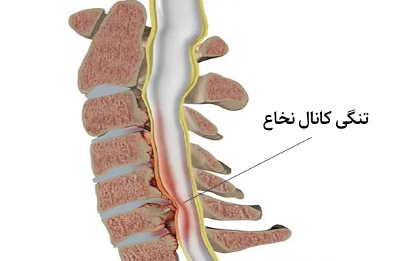 تنگی نخاعی کانال نخاع