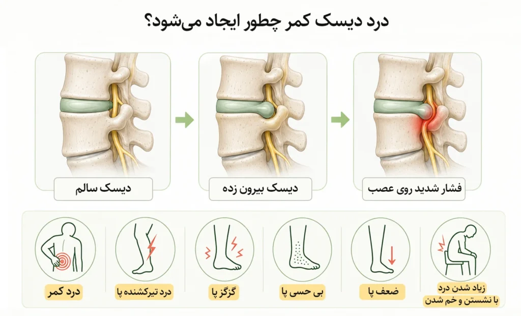 درد دیسک کمر چطور ایجاد می‌شود؟