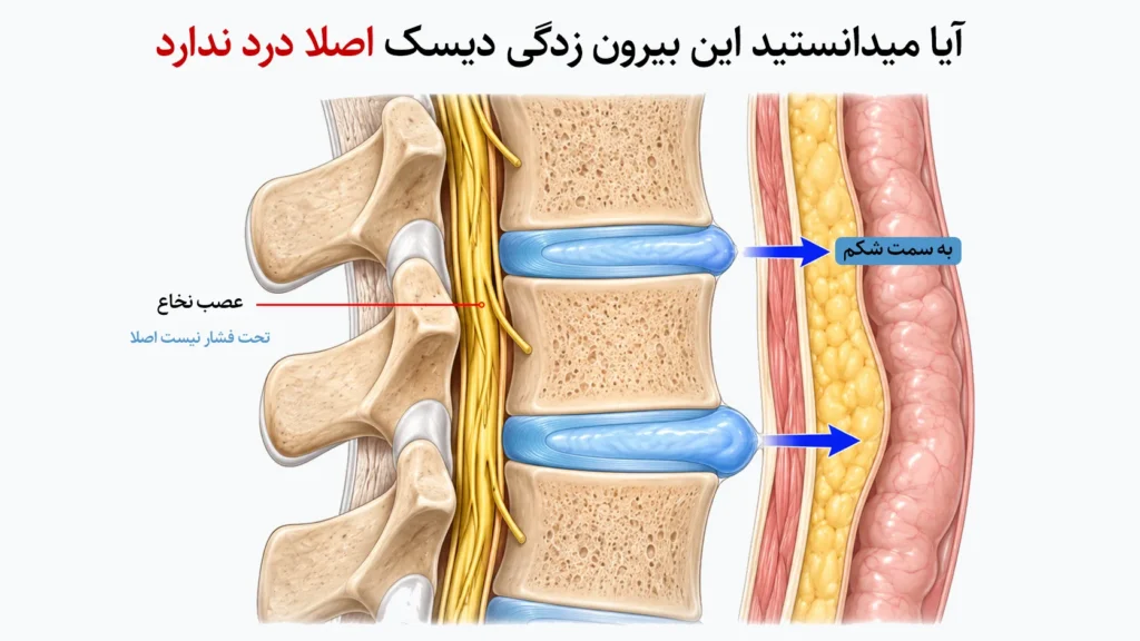 دیسک زیر به سمت شکم بیرون زده 1