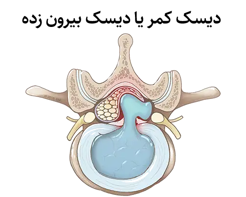 تفاوت تنگی کانال نخاع با دیسک کمر | روش های درمانی توسط دکتر کملاخ 5 دیسک کمر یا دیسک بیرون زده