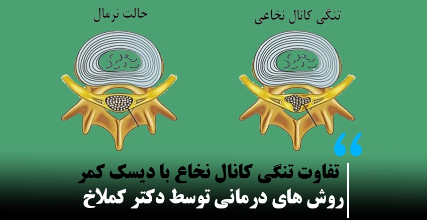 تفاوت تنگی کانال نخاع با دیسک کمر