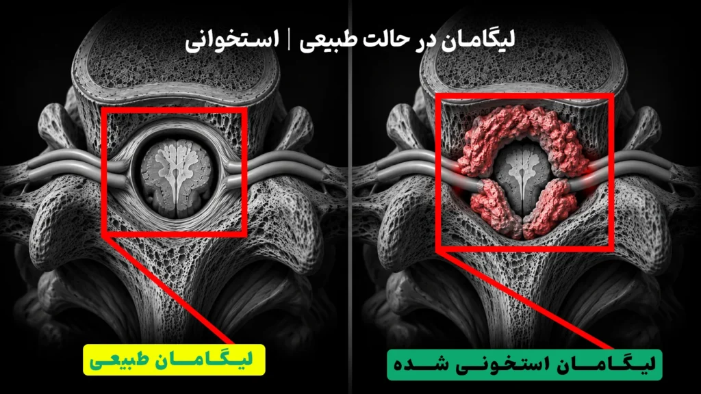 لیگامان طبیعی + لیگامان سفت شده