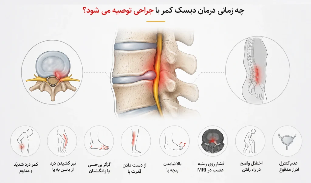 چه زمانی درمان دیسک کمر با جراحی توصیه می شود؟