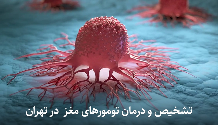 تشخیص و درمان تومورهای مغز
