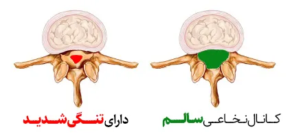 تنگی کانال نخاعی؛ علائم، تشخیص، درمان و زمان جراحی 8 تنگی کانال نخاع سالم و تنگی کانال شدید در نخاع