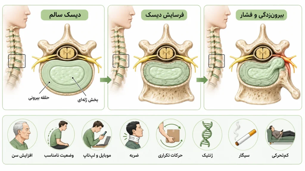 دیسک گردن چگونه ایجاد می‌شود؟