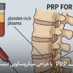 مقایسه روش PRP با جراحی میکروسکوپی دیسک کمر