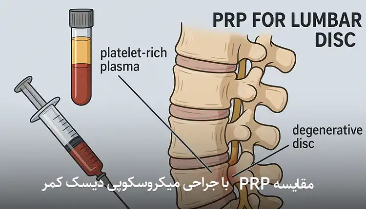فرق و مقایشه روش PRP با با جراحی میکروسکوپی دیسک کمر