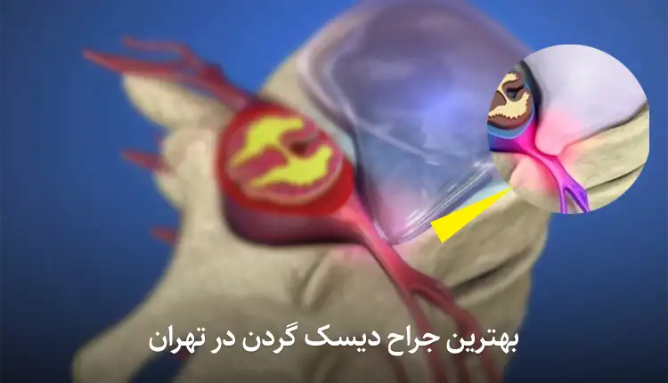 دکتر خلیل کملاخ به‌عنوان بهترین جراح دیسک گردن در ایران شناخته می‌شود
