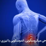 مقایسه جراحی میکروسکوپی، اندوسکوپی یا لیزری دیسک کمر