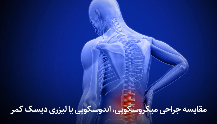فرق آندوسکوپی با میکروسکوپی با دیسک کمر در تهران.webp