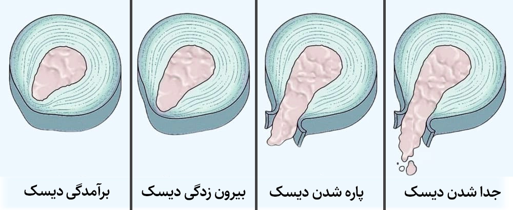 بهترین متخصص دیسک گردن در تهران برای درمان سریع در 1404 1 انواع پارگی و خرابی دیسک کمرگردن
