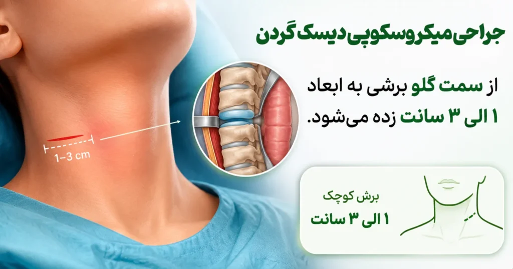 برش از سمت گلو در میکروسکوپی دیسک گردن