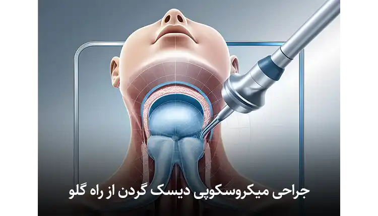 جراحی میکروسکوپی دیسک گردن | توسط استاد دانشگاه ستون فقرات 2 جراحی میکروسکوپی دیسک گردن از راه گلو