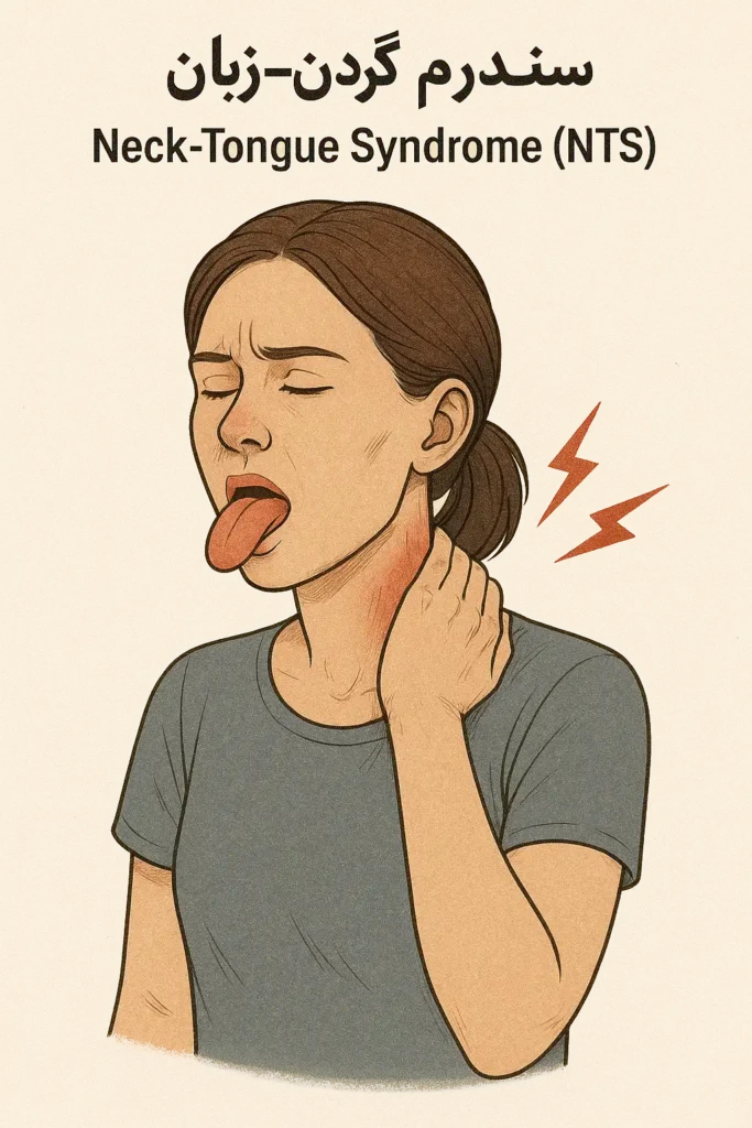 سندرم گردن زبان
