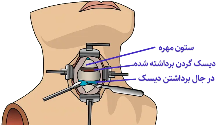 جراحی میکروسکوپی دیسک گردن | توسط استاد دانشگاه ستون فقرات 3 عمل دیسک گردن با روش میکرودیسککتومی