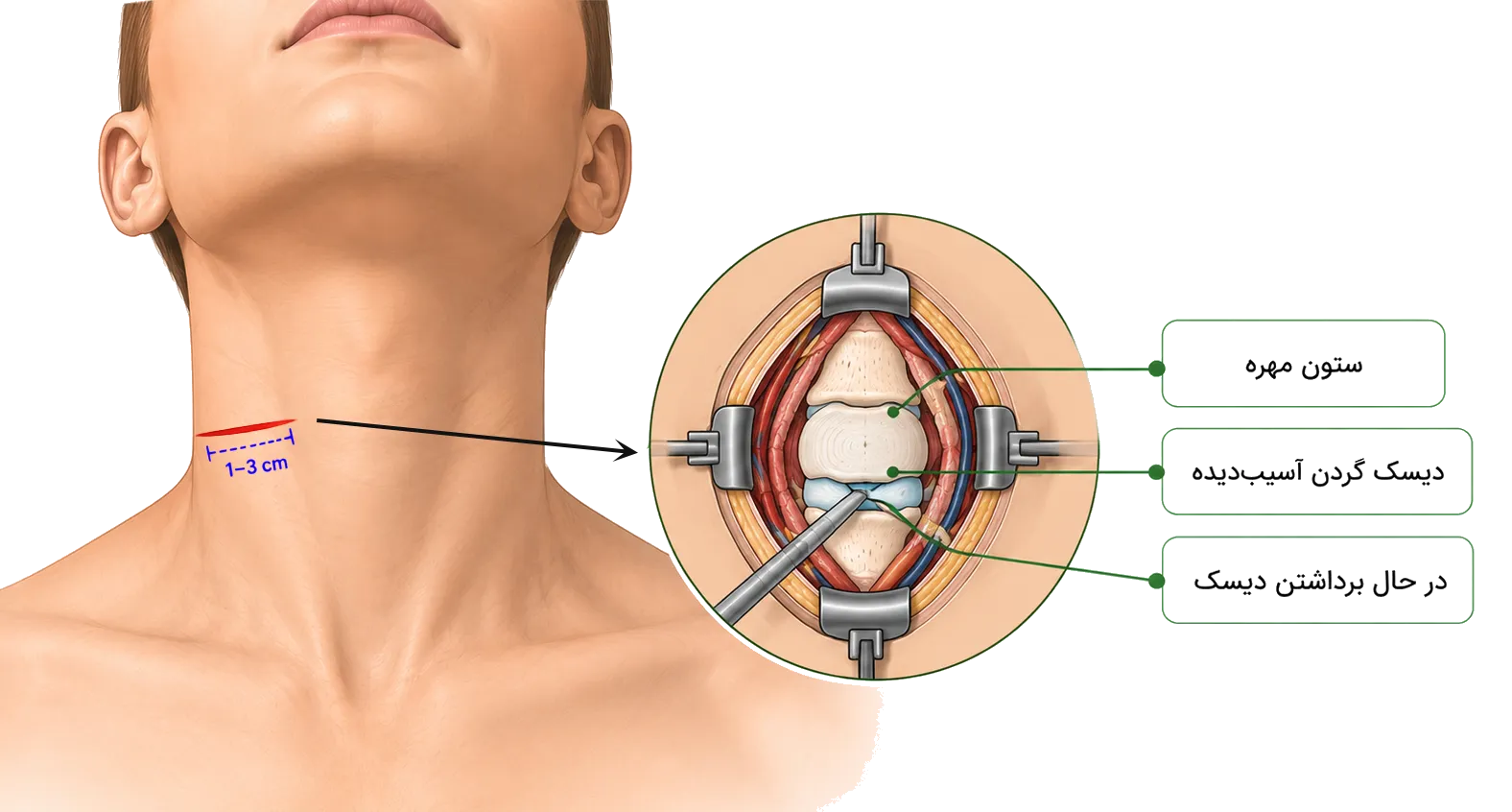 عمل دیسک گردن با میکرودیسککتومی 1