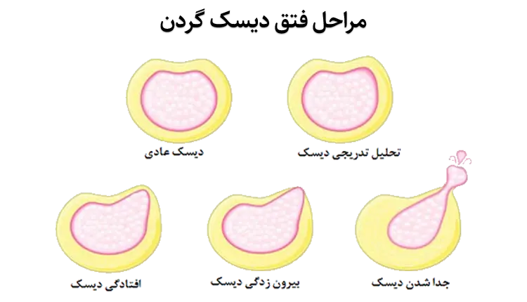 جراحی میکروسکوپی دیسک گردن | توسط استاد دانشگاه ستون فقرات 1 مراحل دیسک گردن چگونه دیسک می شود؟